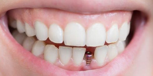 Smile with dental implant