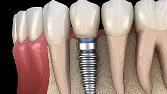 illustration of an implant-supported crown