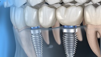 illustration of an implant-supported bridge