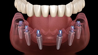 illustration of six dental implants supporting a full denture