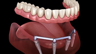illustration of All-on-4 dental implants